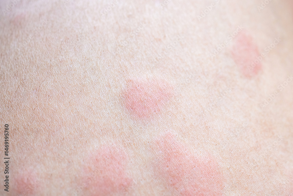 Fototapeta premium Skin allergy rash dermatitis texture close up