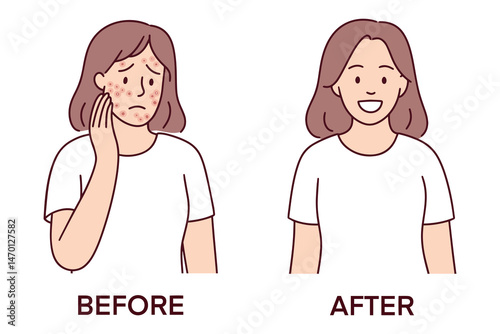 Illustration showing young woman before and after successful acne treatment with visible skin improvement, healing process, clear complexion, recovery from dermatological issues, and better appearance