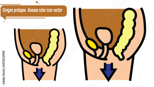  Oregan prolapse  disease color icon vector