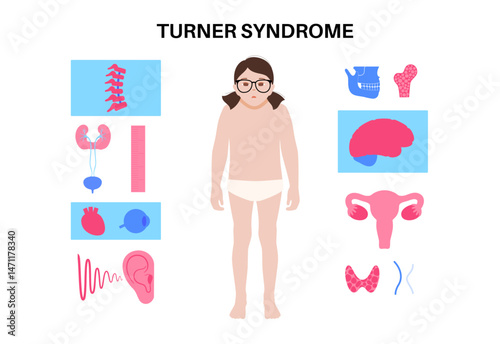 Turner syndrome poster
