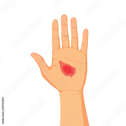 Simplified illustration of burned hand with blister on palm, pain concept