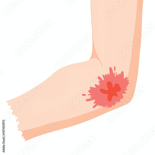 Bruised elbow with scrape on white background, injury concept
