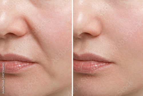 Female nasolabial fold before and after wrinkle smoothing procedures. Correction of the chin and neck shape.