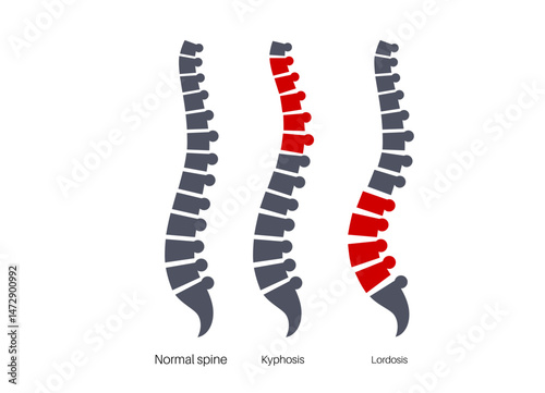 Scoliosis medical poster