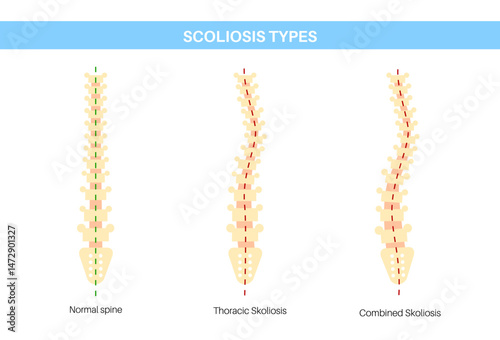 Scoliosis medical poster