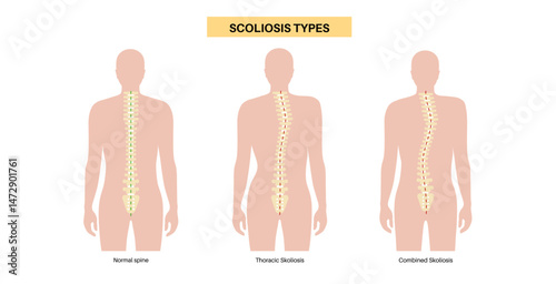 Scoliosis medical poster