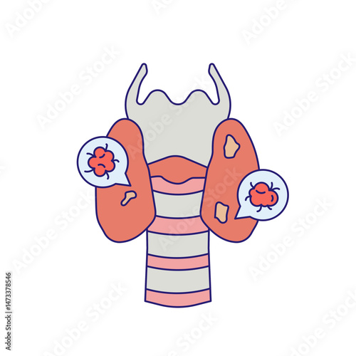 Thyroid cancer