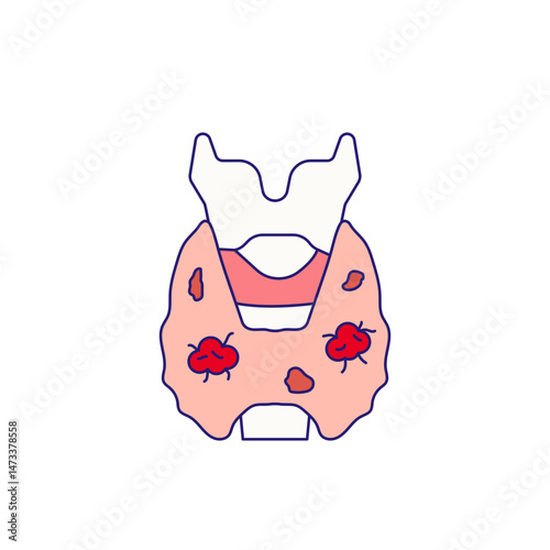 Thyroid cancer