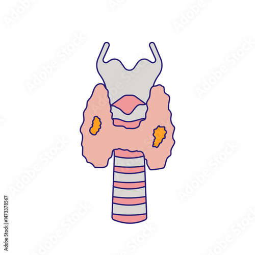 Thyroid cancer