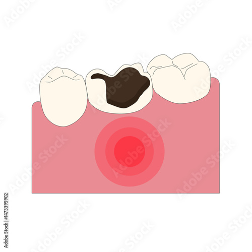 Tooth disease