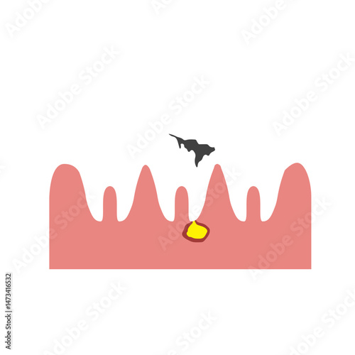 tooth abscess