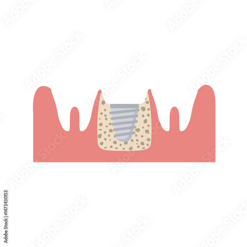 dental implant