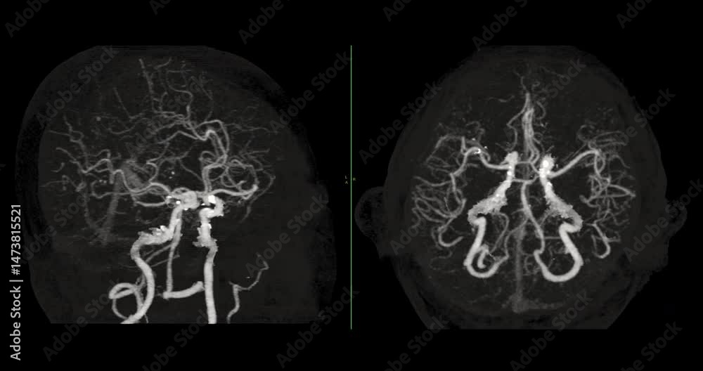 CTA Brain Vascular Footage highlights a detailed of the brain’s ...