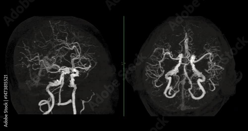 CTA Brain Vascular Footage highlights a detailed of the brain’s vascular network, showing clear visualization of Cerebral arteries and blood flow for diagnostic purposes.