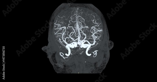 CTA Brain Vascular Footage highlights a detailed of the brain’s vascular network, showing clear visualization of Cerebral arteries and blood flow for diagnostic purposes.