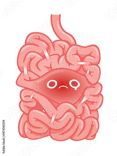 An illustration of the intestines exhibiting signs of constipation.
