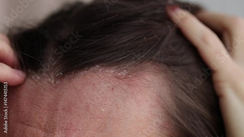 Woman scratching scalp because of dermatitis and dandruff. 4K, slow motion.