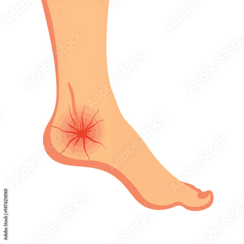 Cracked skin wound on human heel in minimalistic style, foot care