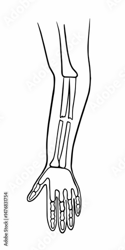 Vector isolated illustration of a closed forearm fracture. Outline drawing of a hand fracture. X-ray of the hand.