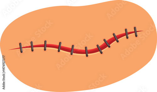 Surgical wound closing with stitches on skin surface, post operative care illustration