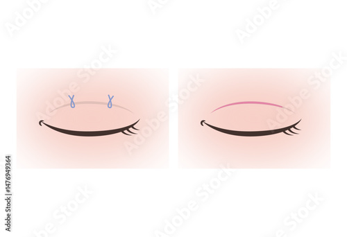 Illustration of Double Eyelid Surgery Methods (Suture and Incision Techniques)