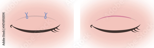 Illustration of Double Eyelid Surgery Methods (Suture and Incision Techniques)