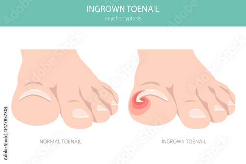 Ingrown toenail, or onychocryptosis, is a nail condition causing pain, redness, and swelling as the nail grows into the skin. Medical infographic. Vector illustration