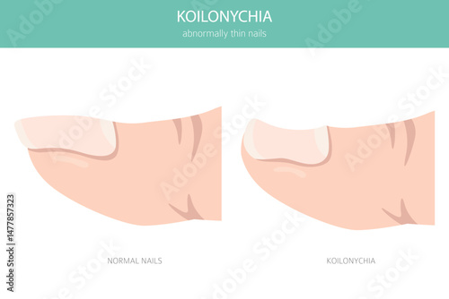 Koilonychia (Spoon Nails) – Medical Infographic Vector Illustration