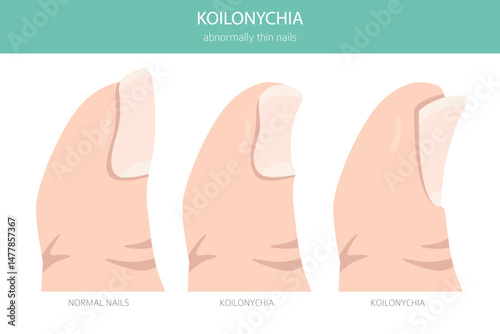 Koilonychia (Spoon Nails) – Medical Infographic Vector Illustration