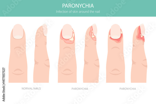 Paronychia is an infection of the nail fold causing redness, swelling, and pain. Often linked to bacteria, trauma, or moisture exposure. Medical infographic design. Vector illustration