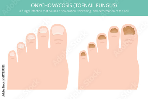 Medical vector illustration of onychomycosis – a common fungal toenail infection. Detailed infographic showing nail discoloration, thickening, and deformationh