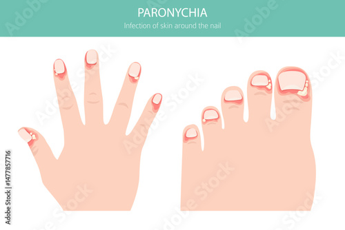 Paronychia is an infection of the nail fold causing redness, swelling, and pain. Often linked to bacteria, trauma, or moisture exposure. Medical infographic design. Vector illustration