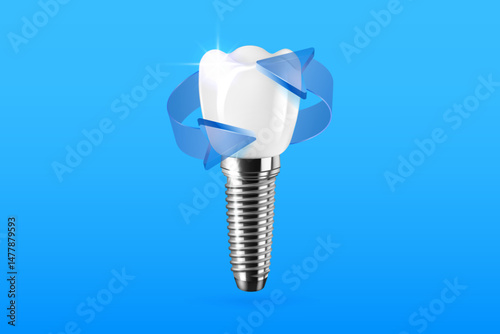 Realistic 3D dental implantation composition with blue arrows. Dental activity illustration