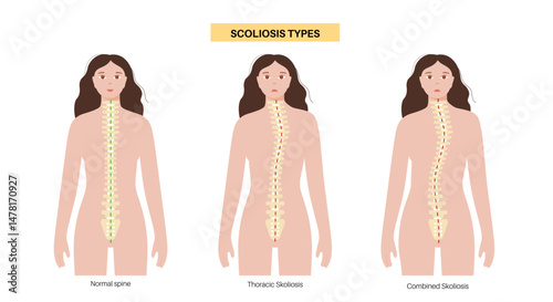 Scoliosis medical poster