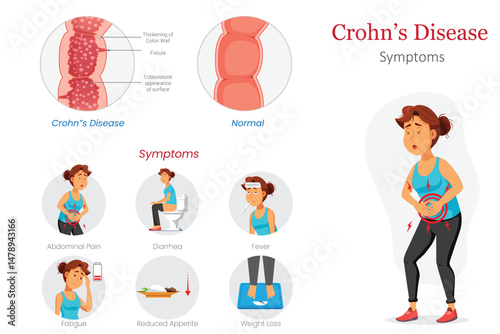 Crohns Disease Diagram Showing Symptoms and Abdominal Pain Example