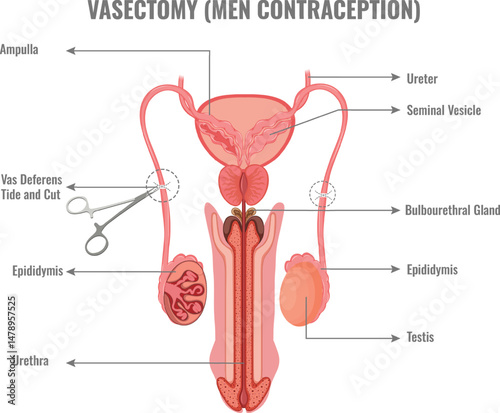 Vasectomy Reliable Male Birth Control Option