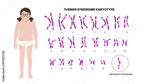 Turner syndrome poster