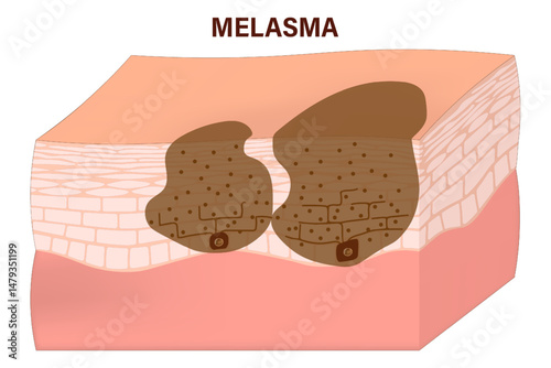 Melasma vector. Epidermal and dermal melasma. Facial skin problems. Human skin with hyperpigmentation.