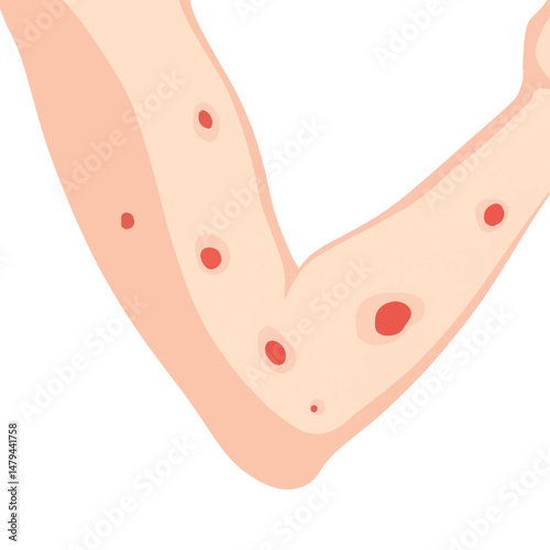 Woman's arms showing mosquito bites in clean vector style, skin irritation