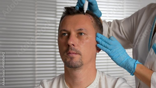 Surgeon Drawing Hairline for Hair Transplant Surgery