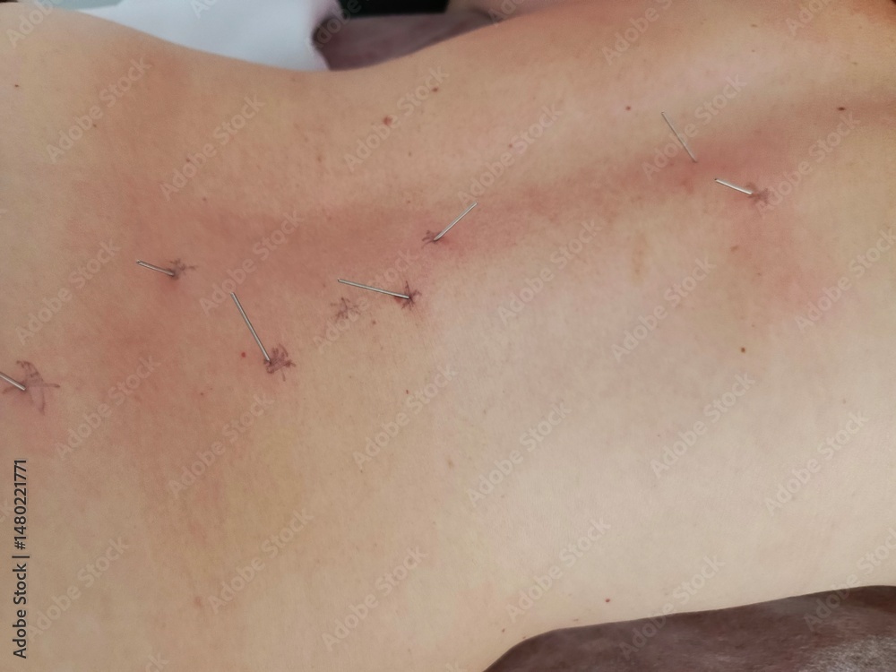 Fototapeta premium Close up of acupuncture needles inserted into a womans bare back during traditional Chinese medicine session for pain treatment.