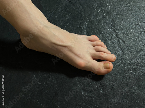 Bunion on woman's foot. Hallux Valgus or foot deformities. Osteoarthritis of the first metatarsophalangeal joint. Deformities of adjacent toes. Hammer toe