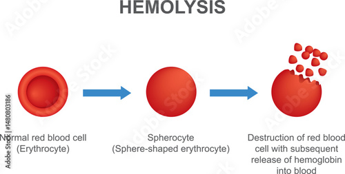 Hemolysis. Normal red blood cell, spherocyte, then destruction of red blood cell with subsequent release of hemoglobin into blood. Vector illustration isolated on white background.