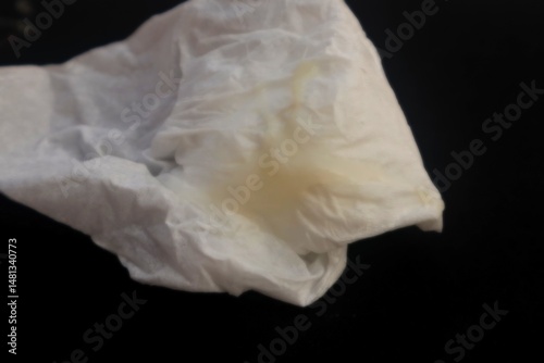 White tissue containing female cervical mucus, a sign of vaginal discharge, close up view.