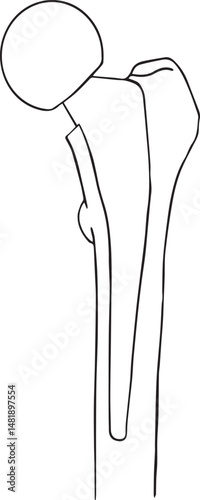 vector illustration of hip after hemiarthroplasty bipolar