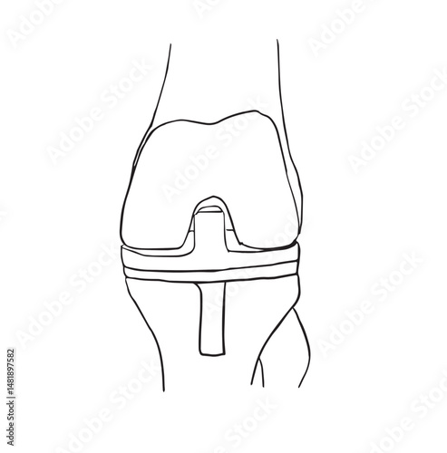 vector illustration of knee after total knee replacement
