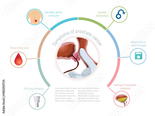 Recognizing prostate cancer symptoms, a medical illustration
