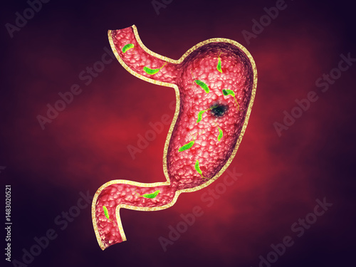 Peptic ulcers are usually caused by an infection of Helicobacter pylori (H. pylori) bacteria. They are open sores on the inner lining of the stomach and the upper part of the small intestine