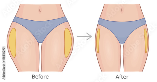 Women's thighs in panties before and after weight loss. Slimming of outer thighs vector illustration.