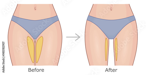Women's thighs in panties before and after weight loss. Slimming of inner thighs vector illustration.